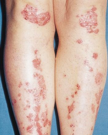 If the disease is active, the plaques will merge to form large confluent areas of psoriasis (Figures 39 43).