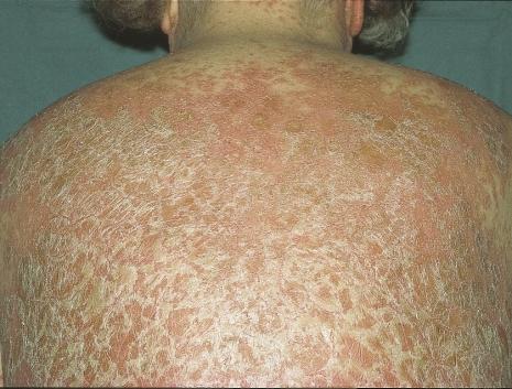 noninvolved skin are visible Figure 44