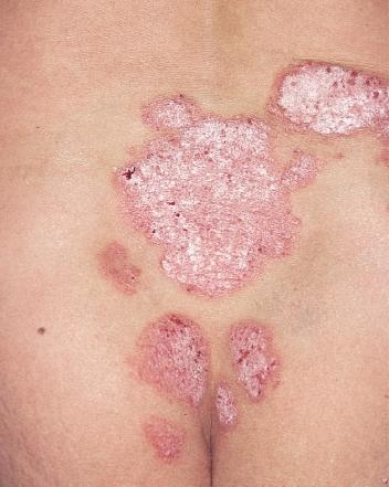 SITES AND CLINICAL PATTERNS Figure 45 Typical plaques of psoriasis over the sacral area, a common site Figure 46 Resolving psoriasis, presenting as annular lesions many years), it may remain static,