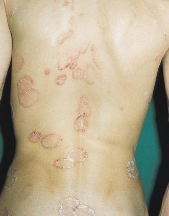When plaque psoriasis clears, particularly when this occurs spontaneously, it tends to clear from the center and the situation is reached when only the periphery of the plaque remains, giving rise to