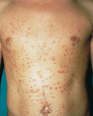 SITES AND CLINICAL PATTERNS Figure 51 abdomen Guttate psoriasis on the chest and upper Figure 52 Guttate psoriasis on the side of the trunk will usually appear.