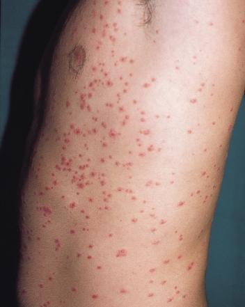 Some individuals have recurrent attacks of guttate psoriasis.