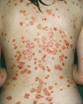 CHRONIC PLAQUE COMBINED WITH GUTTATE PSORIASIS Figure 53 Guttate psoriasis on the back.