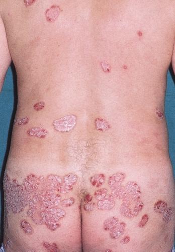 The clinical appearance of psoriasis in the Koebner phenomenon follows the site of injury.