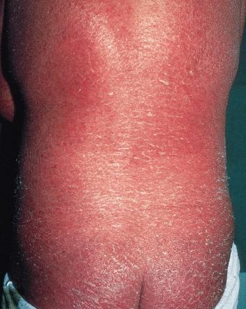 AN ATLAS OF PSORIASIS Figure 58 Erythrodermic psoriasis commonly because treatments for extensive plaque psoriasis have improved over the last 30 years.