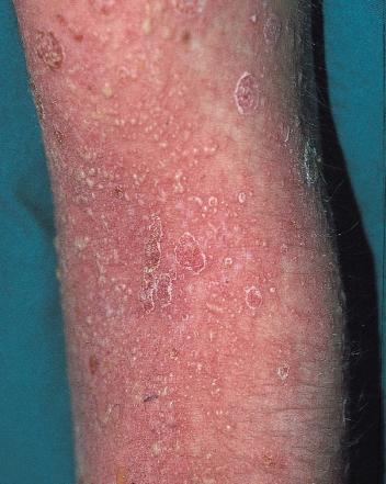 psoriasis small pustules and superficial