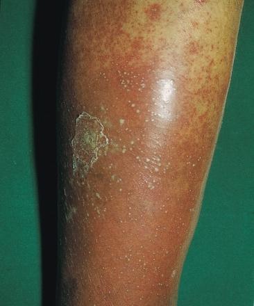 AN ATLAS OF PSORIASIS Figure 63 An area of localized pustular psoriasis on the leg Localized pustular psoriasis This term is used for a distinct clinical entity affecting the palms and soles (Figures