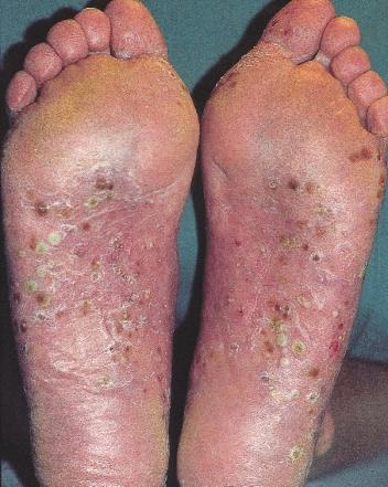 erythema and scaling Figure 65 soles