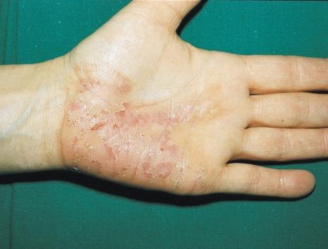 the Figure 66 Pustules and brown papules,