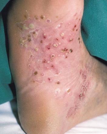 If there are no lesions elsewhere, then it may be difficult to distinguish this form of psoriasis from seborrheic eczema.