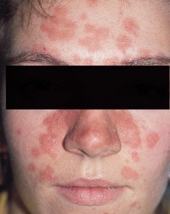 SITES AND CLINICAL PATTERNS Figure 73 Seborrheic psoriasis on the face DIAPER PSORIASIS This term is a misnomer as it implies that infants with this rash have psoriasis, and this is certainly not