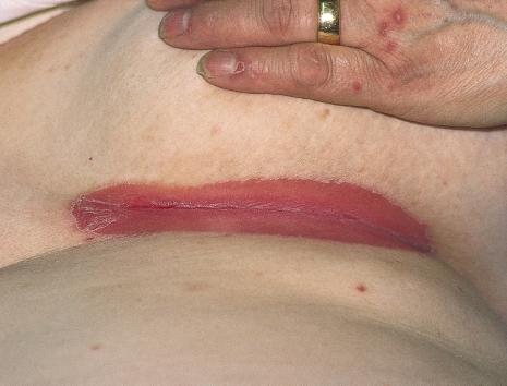 The rash is a confluent red area confined to the diaper area (Figure 80). A few days later small red papules appear on the trunk (Figure 80) and may also involve the limbs.
