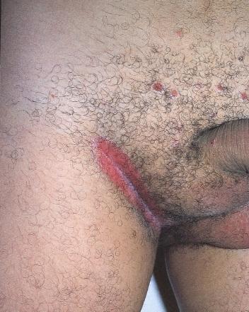 axilla Figure 77 Psoriasis of the