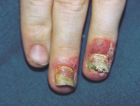 SITES AND CLINICAL PATTERNS Figure 79 Acral psoriasis with nail involvement, a not uncommon presentation in childhood therefore not be used for this type of eruption; a more appropriate term is