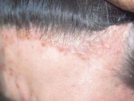 AN ATLAS OF PSORIASIS scalp may present as discrete red raised scaly plaques, as found elsewhere on the trunk and limbs, or it may show diffuse scaling, or may present as very thick plaques of
