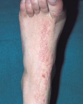 It does, however, occur with severe psoriasis, particularly the erythrodermic form of the disease.