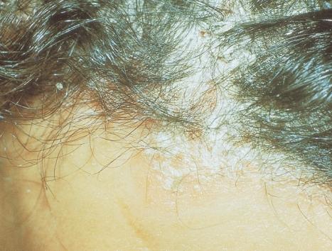 Figure 86 Hair loss in scalp