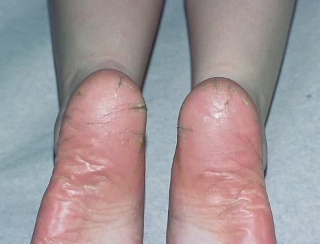 SITES AND CLINICAL PATTERNS Figure 93 Fissuring in psoriasis of the soles Another form of palmar/plantar psoriasis presents as red fissured skin (Figures 92 and 93).