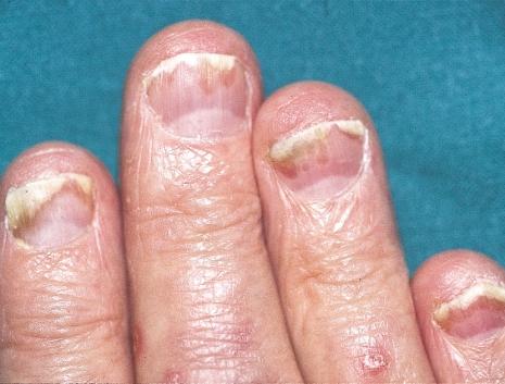 bacteria under the nail in onycholysis Figure