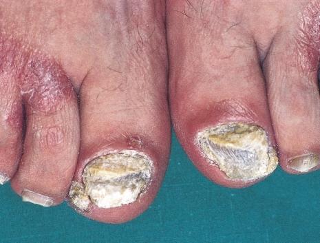 dystrophy of the nail plate