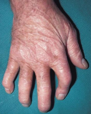 (2) Exclusive involvement of the distal interphalangeal joints of the toes or fingers.