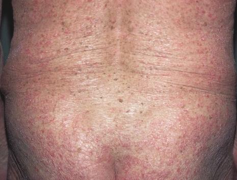 TREATMENT Figure 118 Numerous lentigos due to long-term PUVA for severe psoriasis In contrast to squamous cell carcinoma, there has been only a modest increase in basal cell carcinomata and these
