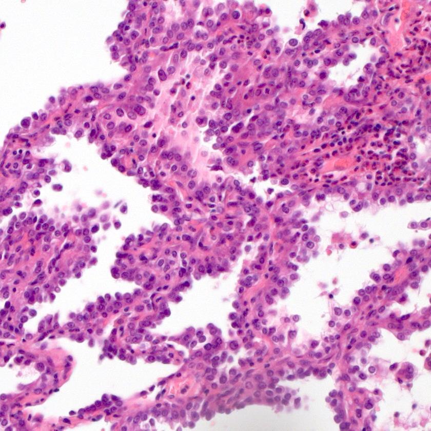 Lepidic pattern (formerly: bronchoalveolar carcinoma) Warth A, J Clin