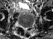 walls; often have papillary projections Presence of papillary projections is helpful to distinguish LMP tumours from benign