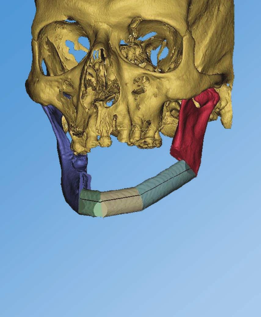 Case Report Reconstruction of a Mandibular