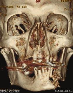 operative radiation therapy twelve years ago. During his initial consultation, he complained of left mandibular pain and intermittent drainage from his left mental area.