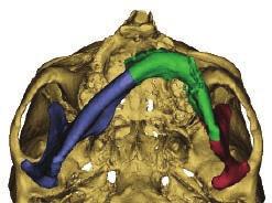 CT scans were uploaded into Synthes ProPlan CMF to create three-dimensional images for preoperative planning.