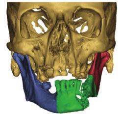 In this protocol the patient is aligned without a gantry tilt. The head is stabilized to prevent motion with the jaws slightly opened, with or without a bite block.