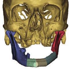 to be used. The resection was planned from the left mandibular angle to just anterior of the right mental foramen in order to preserve sensation to the right lower lip. Figures 5 7.