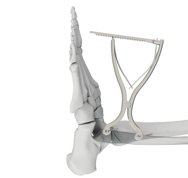 distal fibula below the fracture.