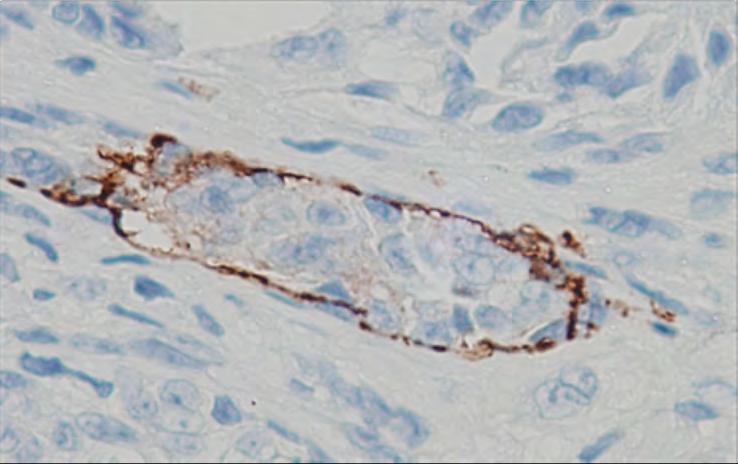 IHC: Prognosis Mitotic figures ( /mm2) in the dermal component of the primary
