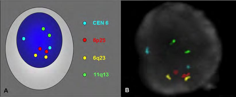 FISH in Melanocytic Lesions Five probes: CEN9 (centromere 9) RREB1 (6p25) MYB