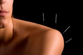 What is Acupuncture? Acupuncture is the placement of fine needles into specific location into the skin.