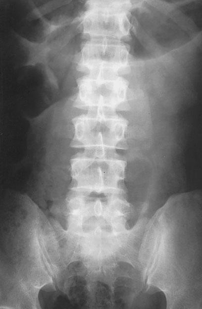 98 Large left paraduodenal hernia descending colonic gas (Fig. a), and clustered dilated small bowel loops with air collection in the left abdomen was noted at follow up plain film one day later (Fig.