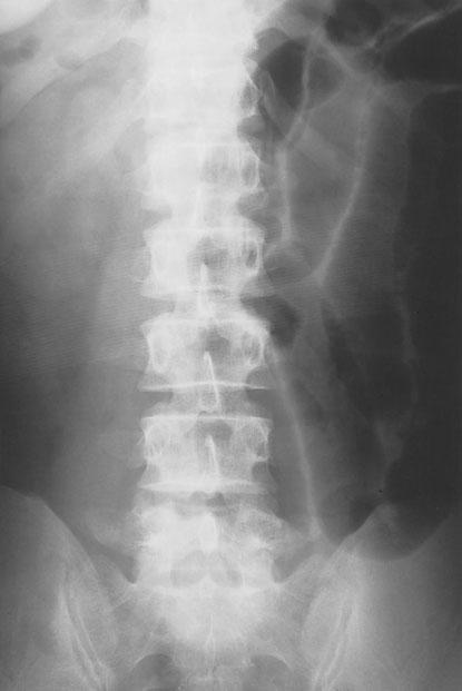 Follow up plain film 4 days later displayed grouped dilated small bowel loops in the left and lower abdomen with medial displacement of the descending colon (Fig. 2b).