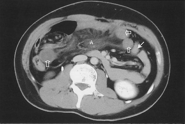 Pre-contrast CT scan at the level of the pancreatic body and tail demonstrated grouped small bowel loops (black asterisk)