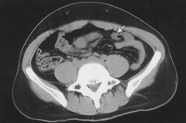upon the posterior wall of the stomach (black arrow). b.