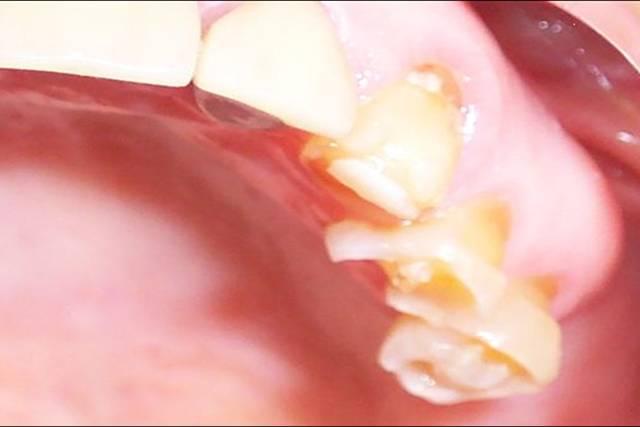 Picture of Patient s teeth that are dissolving because of uncontrolled Dry Mouth.