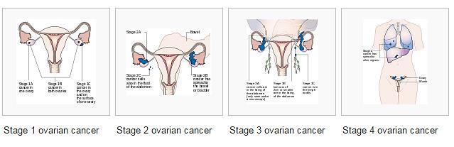 Stages 1- one or both ovaries II-other pelvic organs III-outside