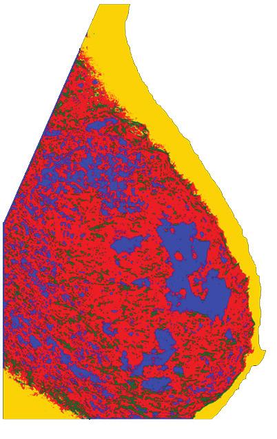 The tissue specific areas are: nodular (red), linear (green), homogeneous (blue) and radiolucent (yellow). Note that nodular tissue was over-segmented when using the moments based method.