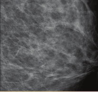 250 Mammography Recent Advances 8 Will-be-set-by-IN-TECH Fig. 1.