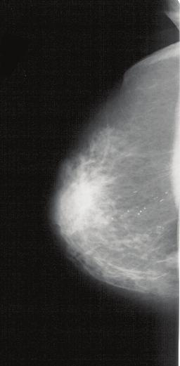304 Mammography Recent Advances 12 Will-be-set-by-IN-TECH FFT of a region exhibiting a unidirectional periodic pattern FFT of a region without any evident periodic pattern Fig. 6.