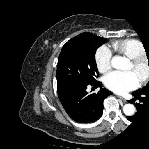 1a-b) showed reduced masses after NAC (white arrow). DBT (Fig.