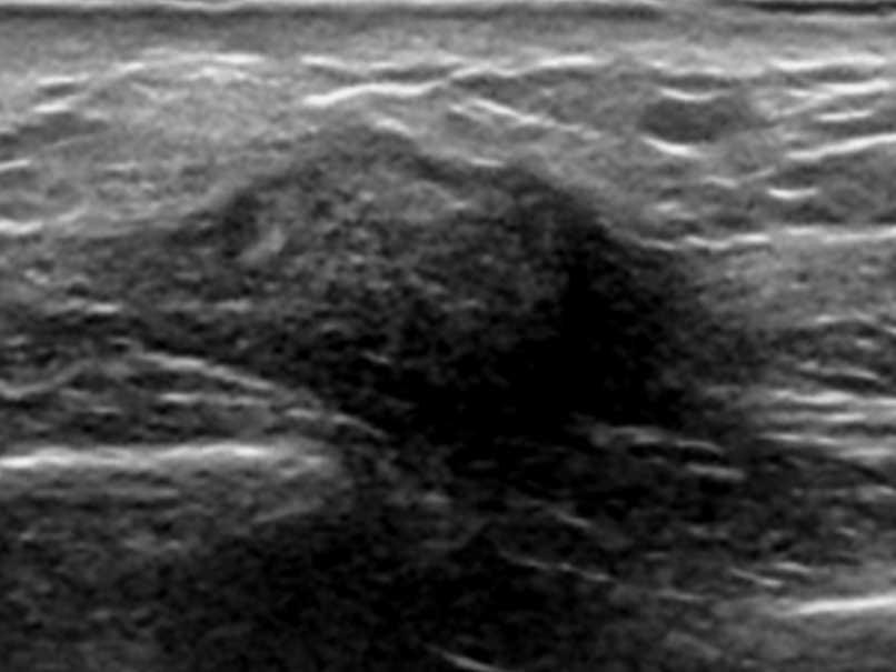Fat Necrosis 383 5.3.4 Fibrous scar As mentioned above, sonography can be very useful in the diagnosis during the initial phases of fat necrosis.