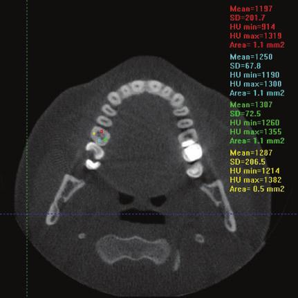18 Originalni radovi Fig. 1. The measurement of circumpulpal dentine density with the use of programme I- CAT Vision for dental volumentric tomography I-CAT. Slika 1.