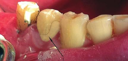 At the stage of preparation of the tooth to reduce the effects of shrinkage is achieved by excision of the thinned ridges, rounded internal corners of the cavity.